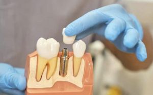 Зубные импланты и опасения пациентов