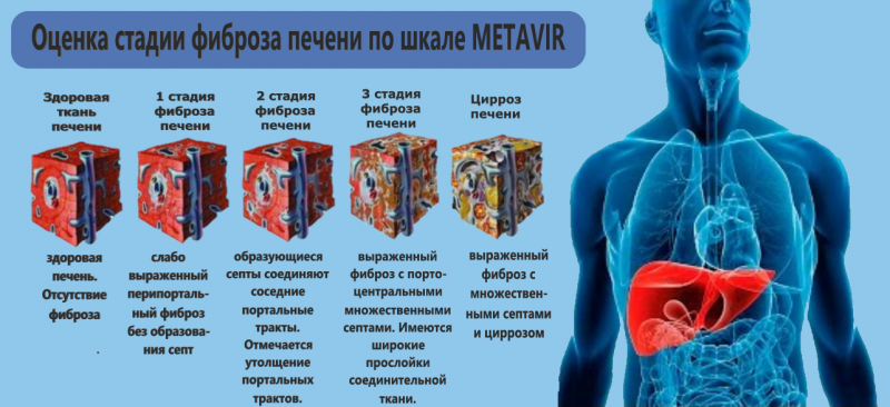 Шкала METAVIR